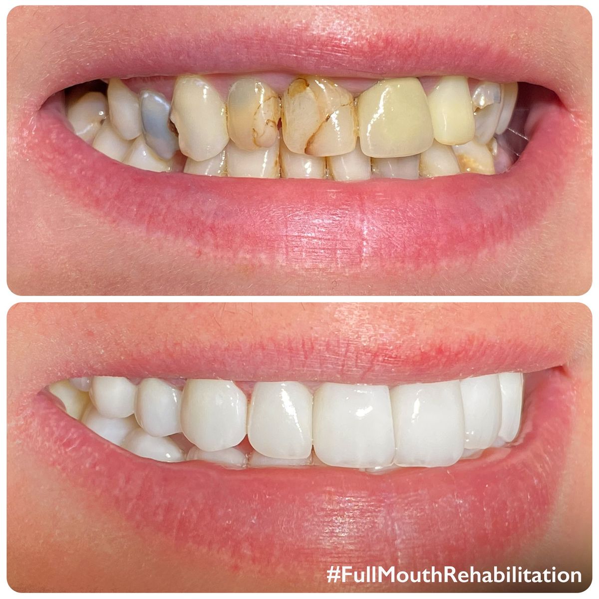 full mouth rehabilitation